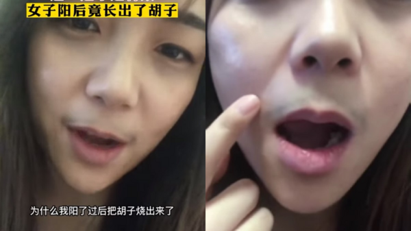 江蘇女子確診後燒到長鬍子